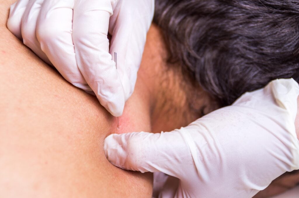 the-importance-of-working-with-a-licensed-acupuncturist