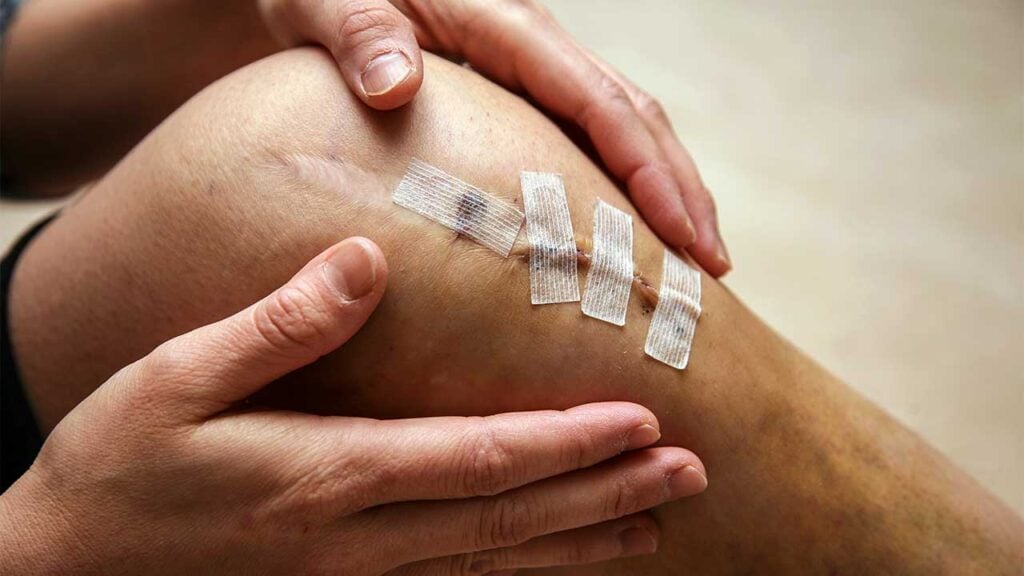 acupuncture-after-acl-surgery