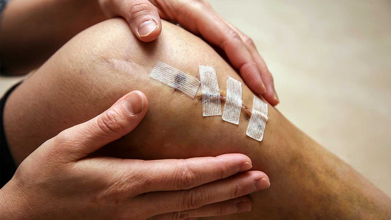 acupuncture-after-acl-surgery