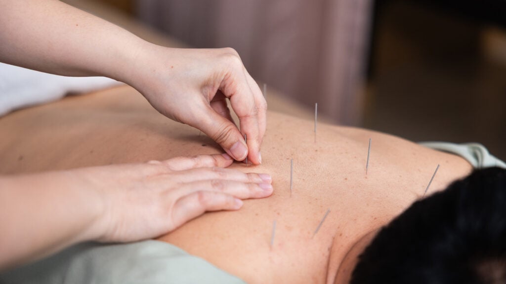 does-acupuncture-hurt