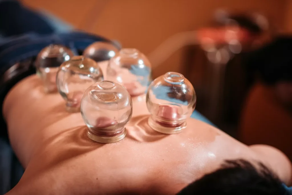 cupping-for-back-pain