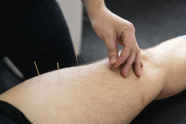 dry-needling-side-effects