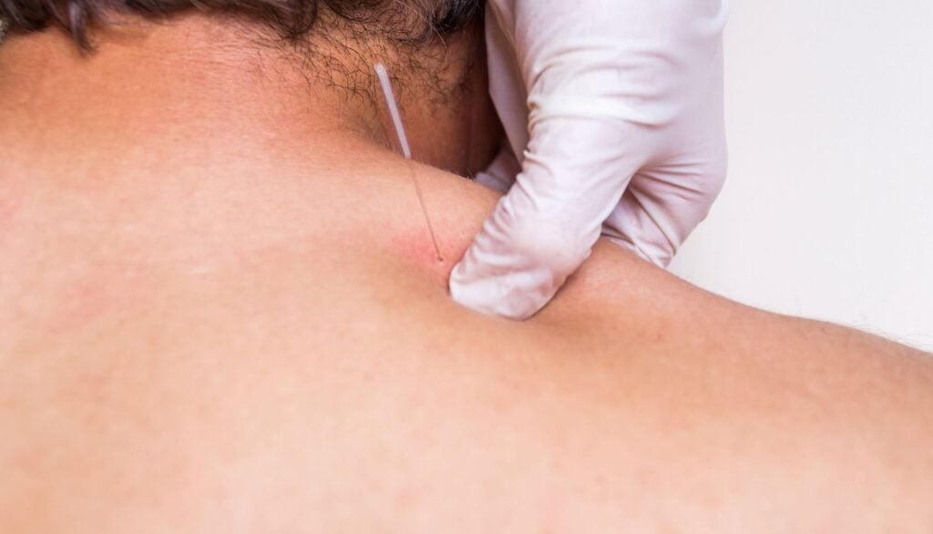 what-to-do-after-dry-needling