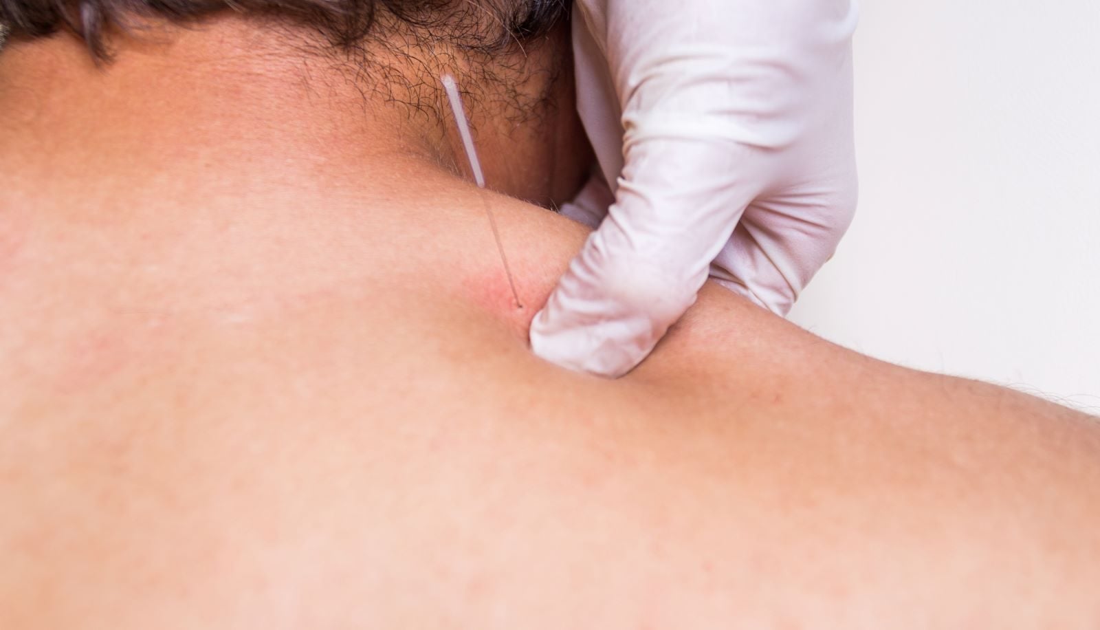 what-to-do-after-dry-needling